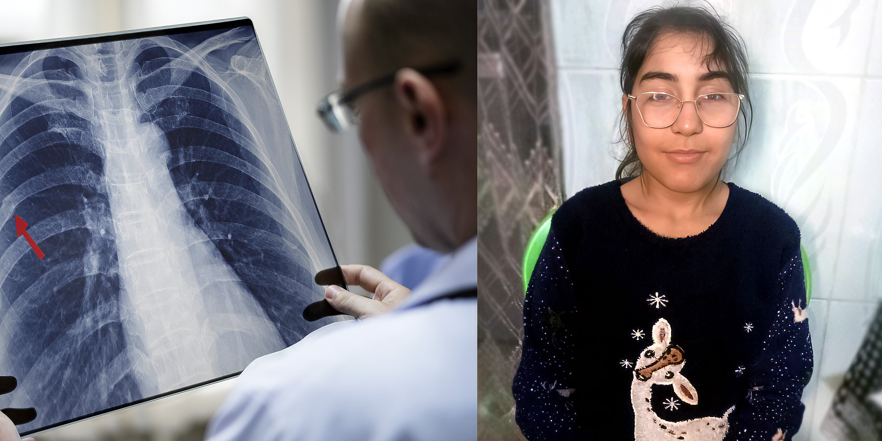 The medical team on the ground confirmed the need for a second surgical procedure for 17 year old Sidra. The medical team on the ground confirmed the need for a second surgical procedure for 17 year old Sidra.